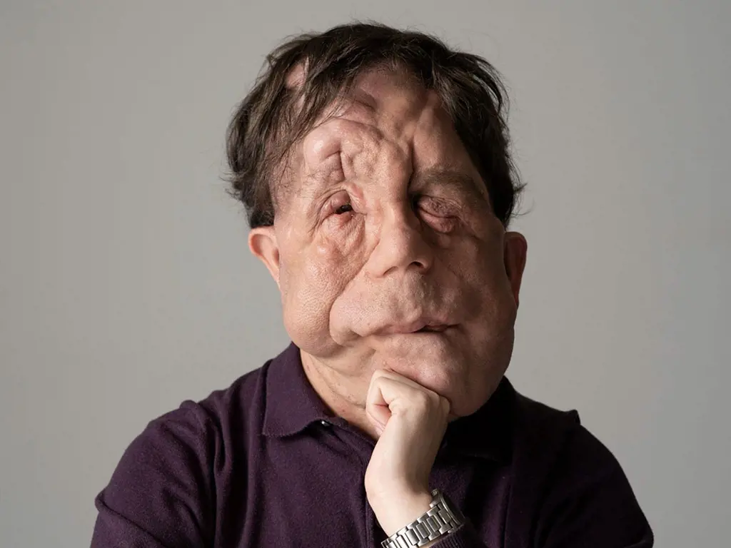 Adam Pearson has appeared in several documentaries and movies.