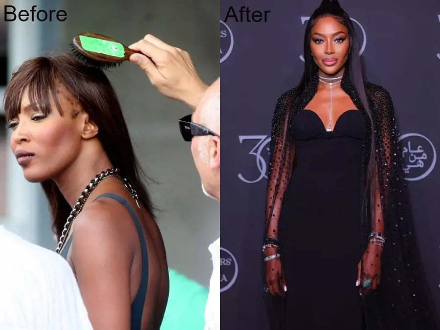 Naomi Campbell, a supermodel, suffers from hair loss as a result of her frequent usage of hair extensions and heat treatment products.