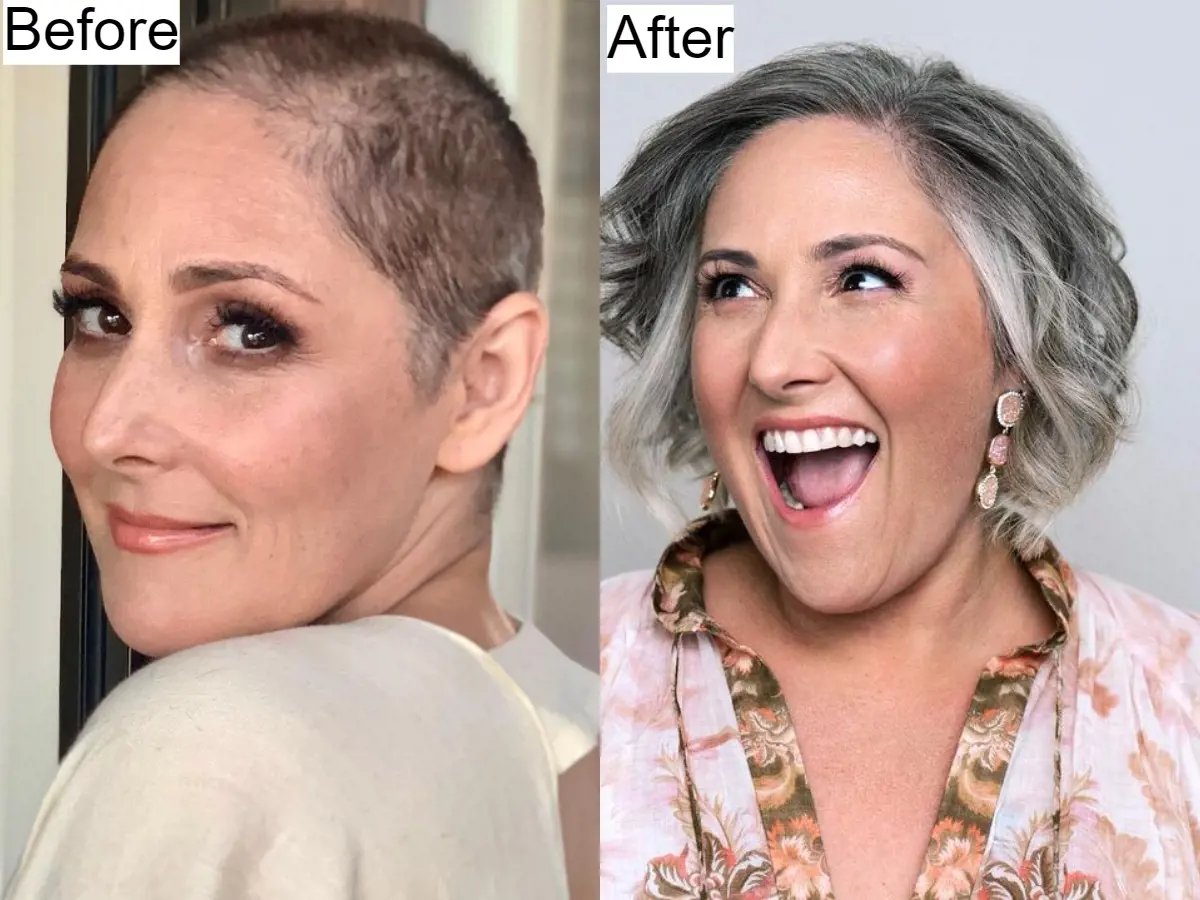 Ricki Lake an American television host and actress was diagnosed with androgenetic alopecia.